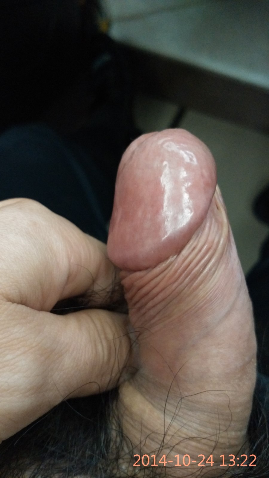求问：冠状沟的小疙瘩是怎么回事？